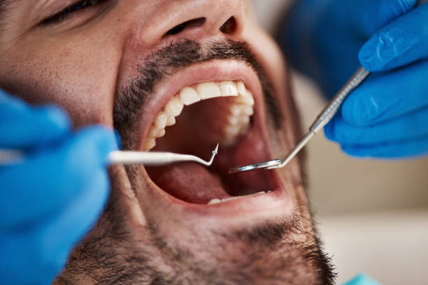 Best Emergency Root Canal Treatment in Peculiar, MO